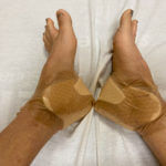 Patient's feet are bandaged after Ankle surgery
