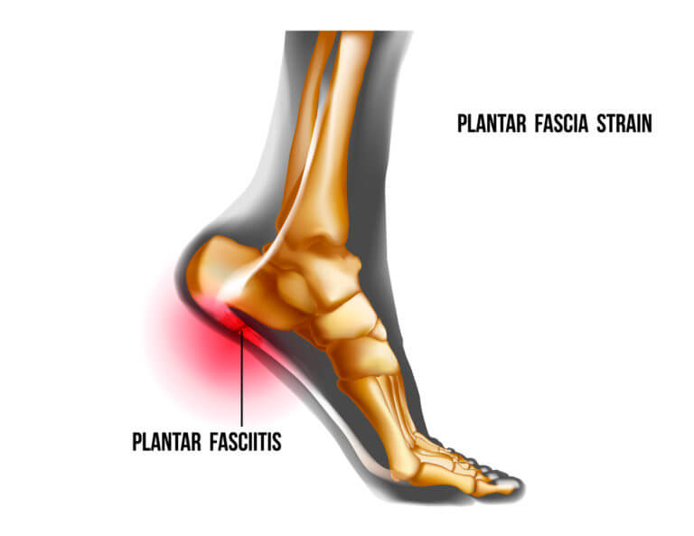 How long does it take to recover from plantar fasciitis surgery? - Foot ...