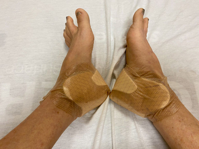 Patient ankle after replacement surgery