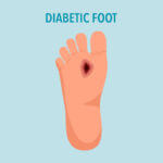 Diabetic foot syndrome concept