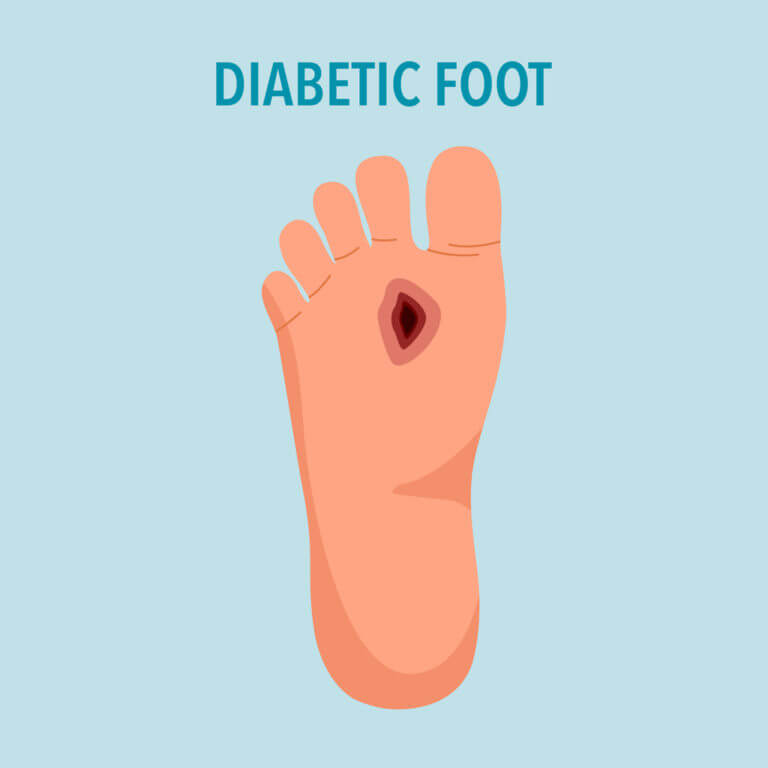 Diabetic foot syndrome concept