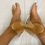 Patient's feet are bandaged after surgery