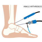 Ankle arthroscopy poster