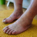 A close-up shot of man's feet with diabetic foot complications.